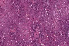 HPV associated squamous cell carcinoma of the oropharynx