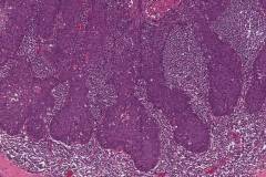 HPV associated squamous cell carcinoma of the oropharynx