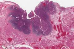 HPV associated squamous cell carcinoma of the oropharynx