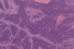 HPV associated squamous cell carcinoma of the pharynx