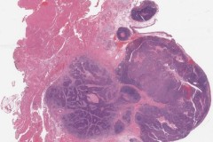 HPV associated squamous cell carcinoma of the pharynx