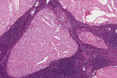 Metastatic nonkeratinizing squamous cell carcinoma to a lymph node