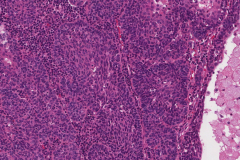 Metastatic nonkeratinizing squamous cell carcinoma to a lymph node