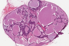 Metastatic nonkeratinizing squamous cell carcinoma to a lymph node