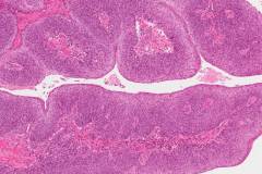 Papillary type nonkeratinizing squamous cell carcinoma of the oropharynx