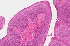 Papillary type nonkeratinizing squamous cell carcinoma of the oropharynx