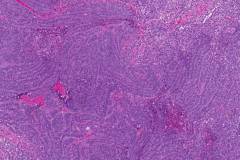 Nonkeratinizing squamous cell carcinoma of the oropharynx