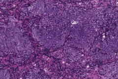 Nonkeratinizing squamous cell carcinoma of the oropharynx