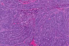 Nonkeratinizing squamous cell carcinoma of the oropharynx