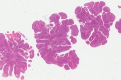 Papillary type nonkeratinizing squamous cell carcinoma of the oropharynx