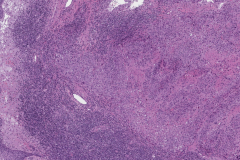 HPV-associated keratinizing squamous cell carcinoma of the oropharynx