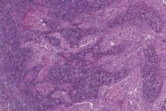 HPV-associated keratinizing squamous cell carcinoma of the oropharynx