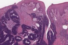 HPV associated squamous cell carcinoma of the oropharynx