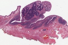 HPV associated squamous cell carcinoma of the oropharynx