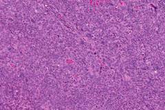 HPV-associated nonkeratinizing squamous cell carcinoma of the oropharynx