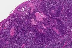 HPV-associated nonkeratinizing squamous cell carcinoma of the oropharynx