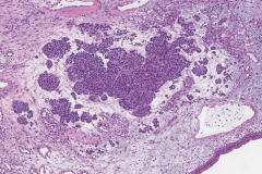 Olfactory neuroblastoma