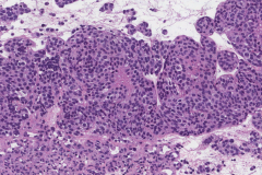 Olfactory neuroblastoma