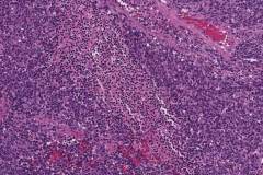 High grade olfactory neuroblastoma