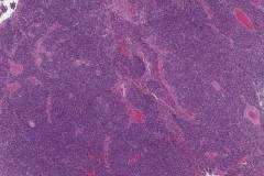 High grade olfactory neuroblastoma