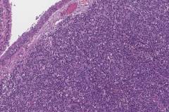 High grade olfactory neuroblastoma