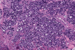 High grade olfactory neuroblastoma