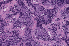 High grade olfactory neuroblastoma