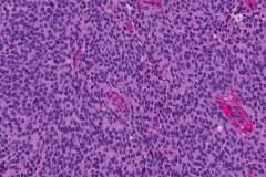 Low grade olfactory neuroblastoma