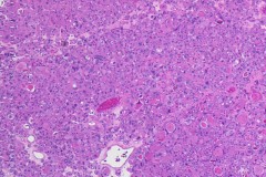 Oncocytic adenoma of the thyroid gland