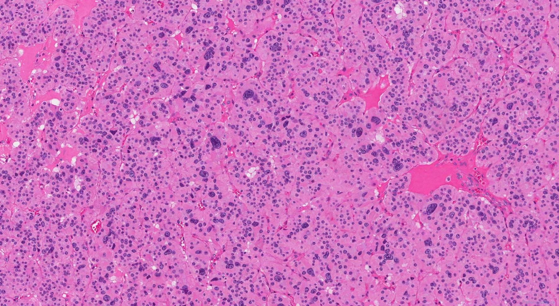 Oncocytic Carcinoma Of The Thyroid Gland | Atlas Of Pathology