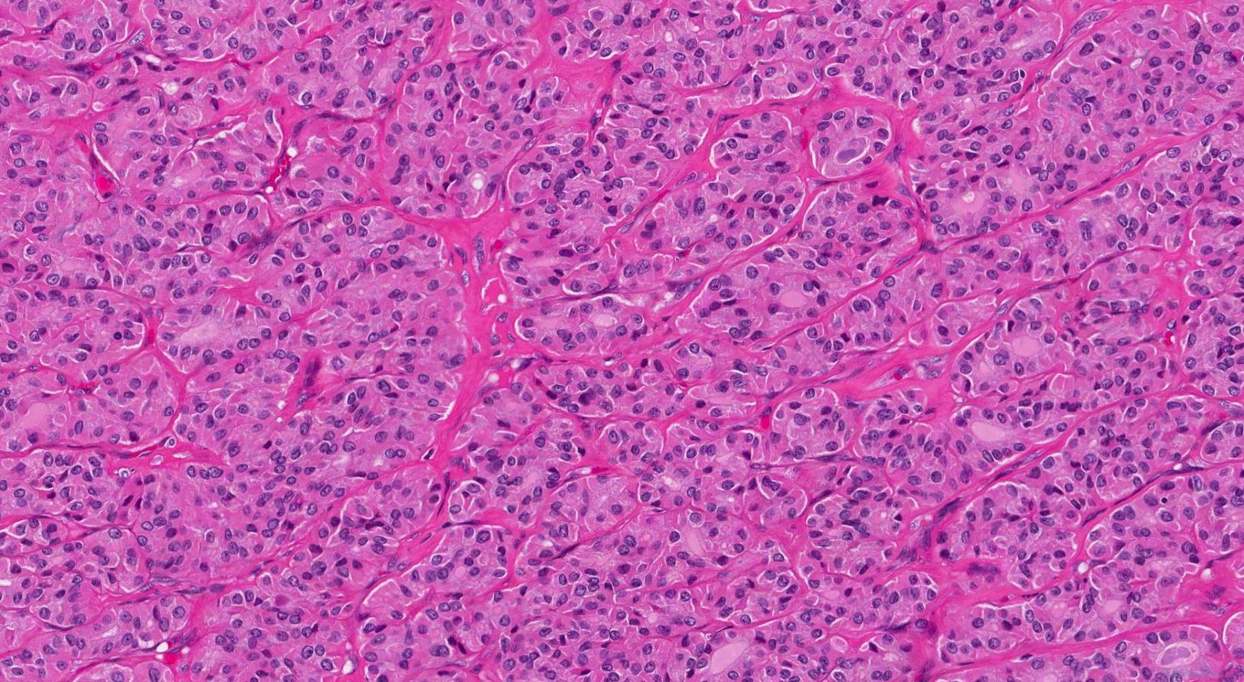 Oncocytic carcinoma of the thyroid gland | Atlas of Pathology