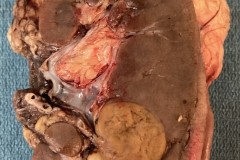 Oncocytoma of the kidney