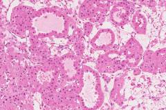 Oncocytoma of the kidney