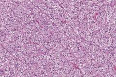 Clear cell oncocytoma of the parotid gland