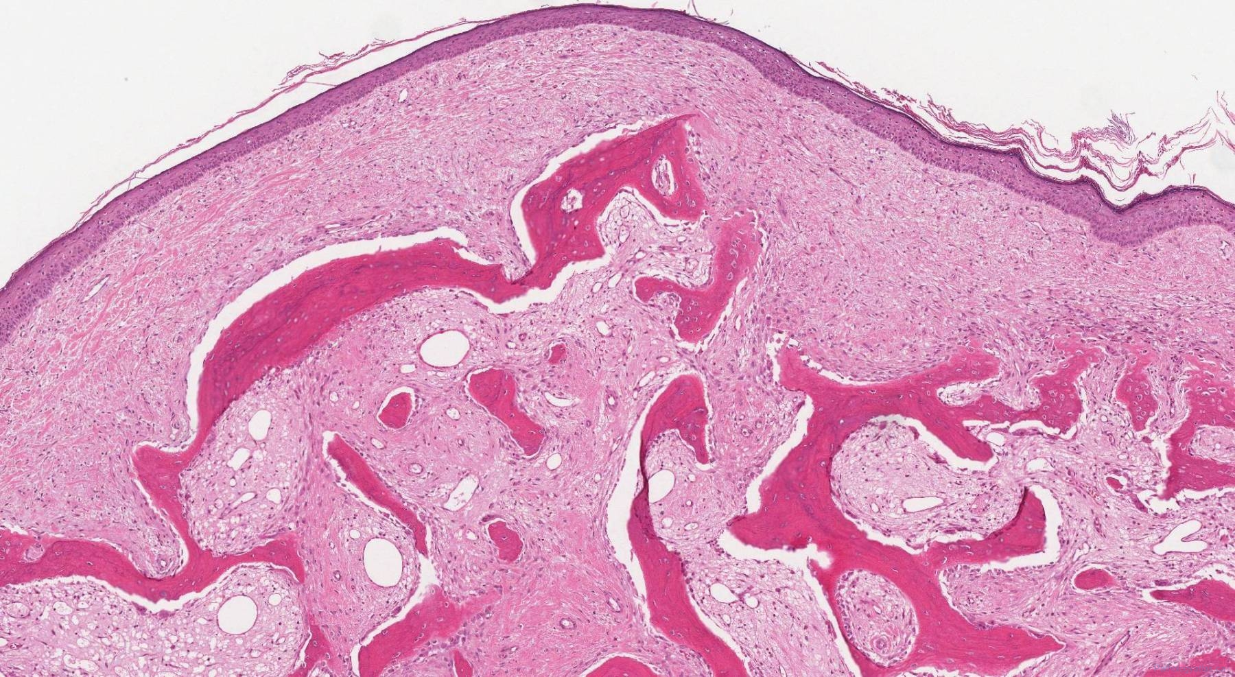 Osteoma Wikidoc