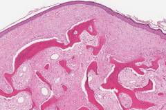 Osteoma of the middle ear