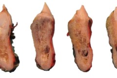 Chondroblastic osteosarcoma of the mandible