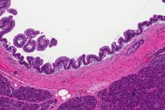 Low grade pancreatic intraepithelial neoplasm