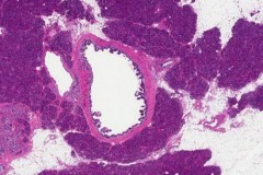 Low grade pancreatic intraepithelial neoplasm