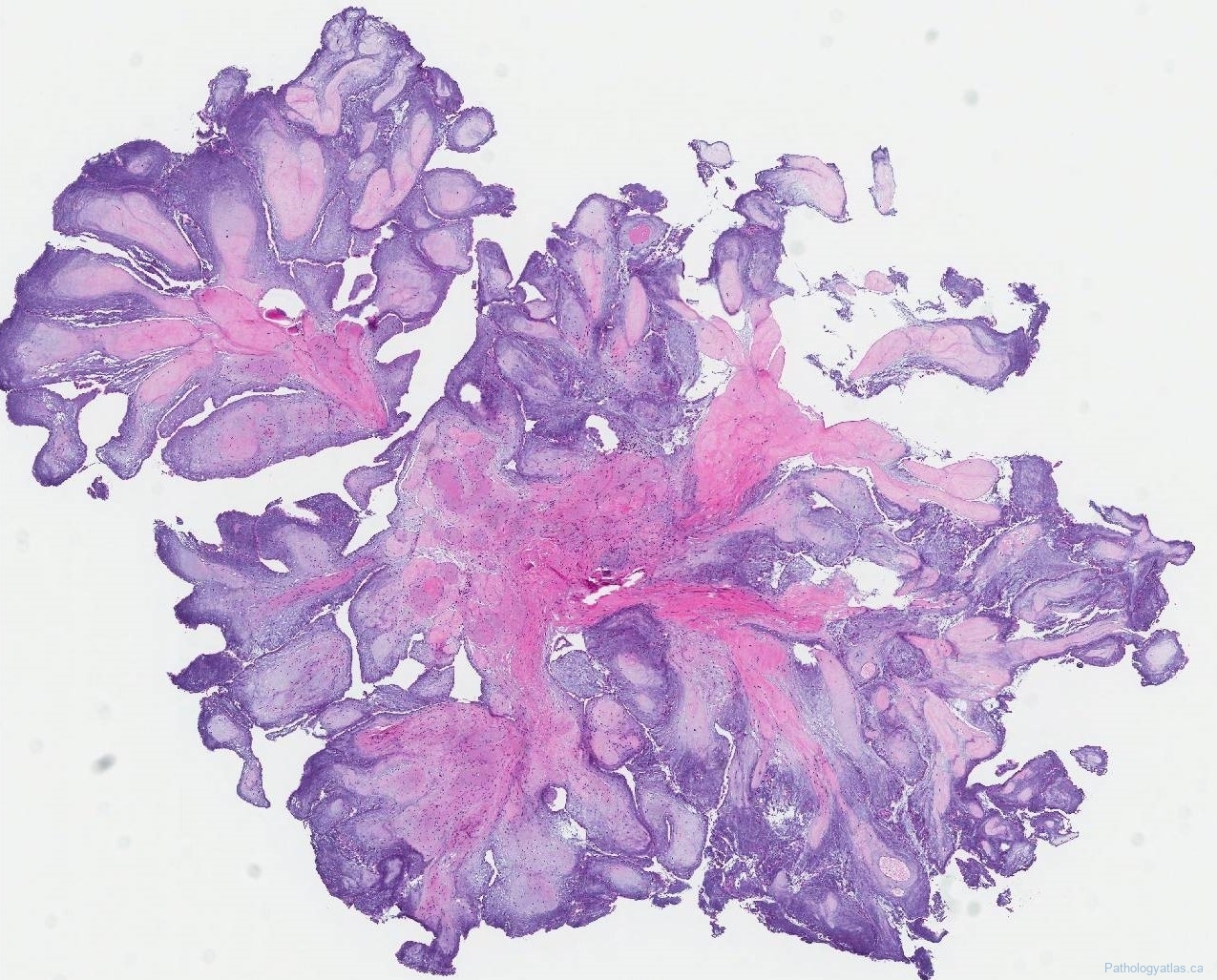 Papillary fibroelastoma | Atlas of Pathology