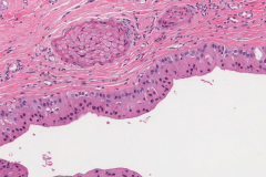 Papillary oncocytic cystadenoma of the tongue