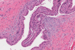 Papillary oncocytic cystadenoma of the tongue