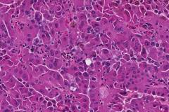 Papillary renal cell carcinoma