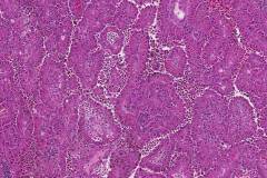 Papillary renal cell carcinoma