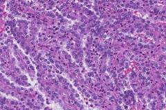 Papillary renal cell carcinoma