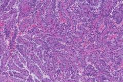 Papillary renal cell carcinoma