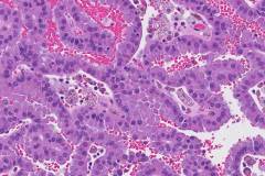 Papillary renal cell carcinoma