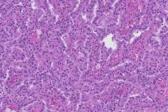 Papillary renal cell carcinoma