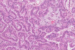 Papillary renal cell carcinoma