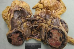 Papillary renal cell carcinoma